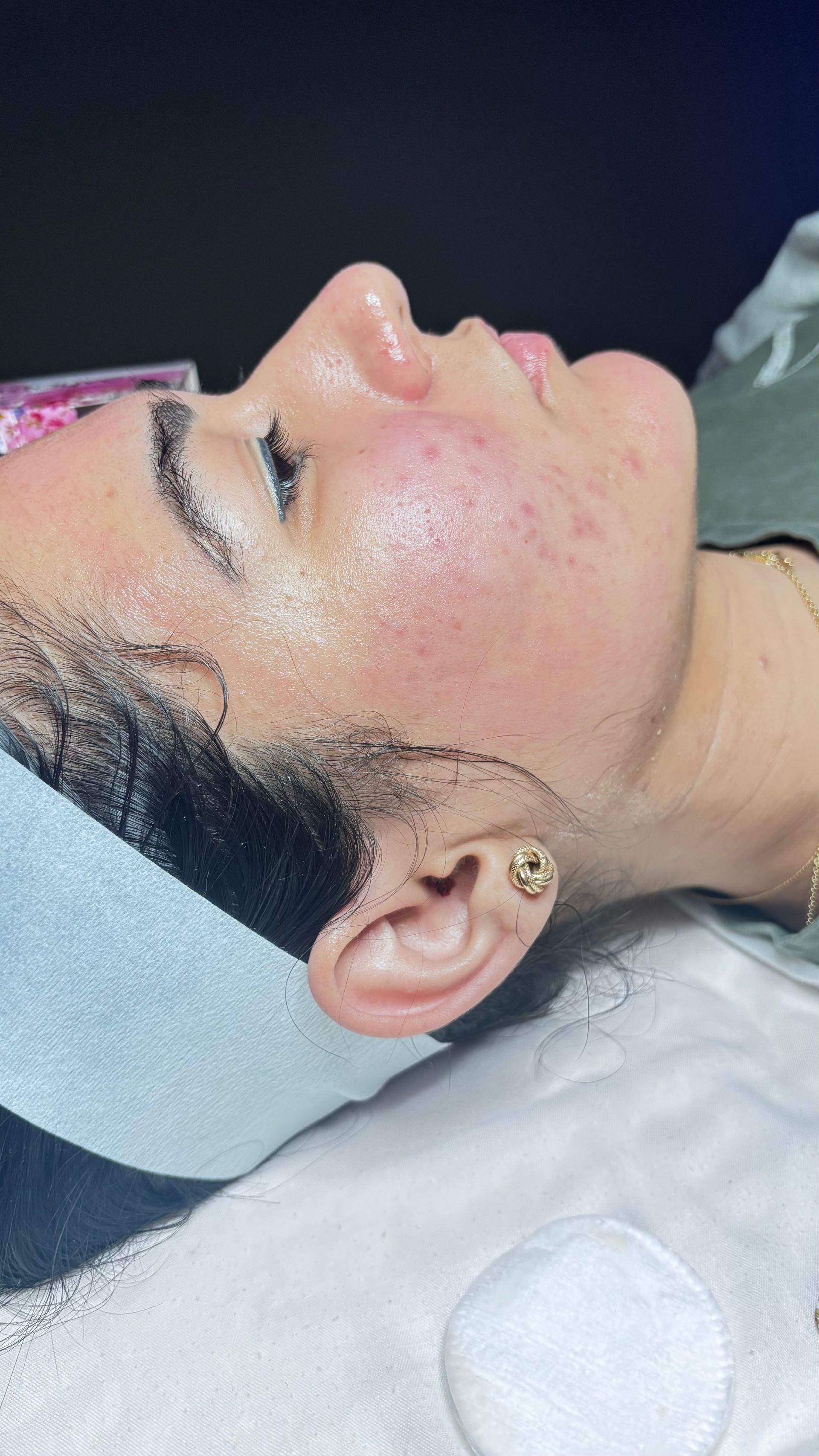 Woman's face with damp skin and red areas. Wearing a headband. Close-up profile view.