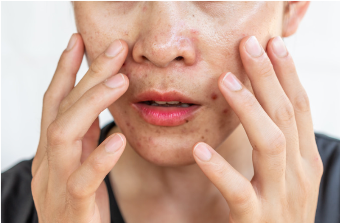 A woman with acne on her face is touching her face with her hands.