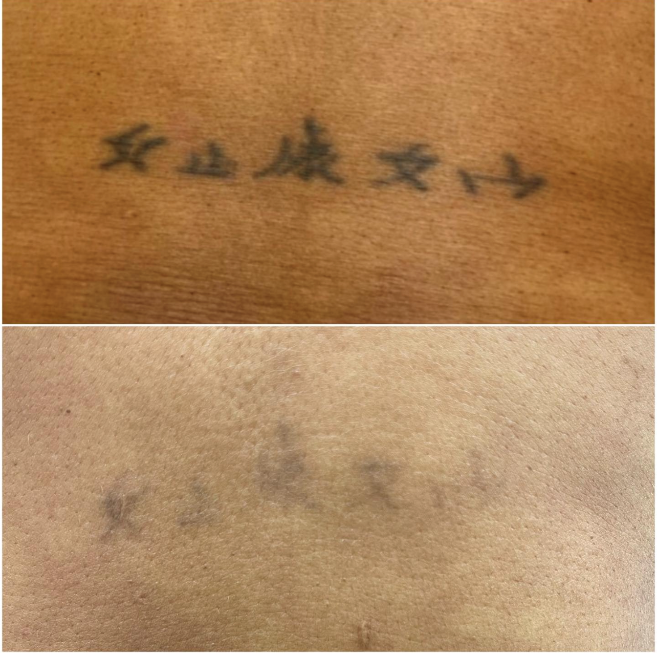 laster tattoo removal services