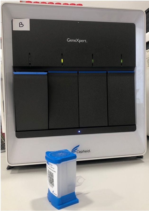 Il test non invasivo Xpert Bladder Cancer Detection