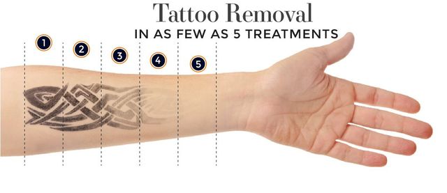 Non-Laser Tattoo Removal Course Singapore | 3Beauties