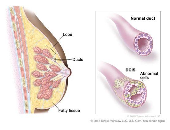 DCIS