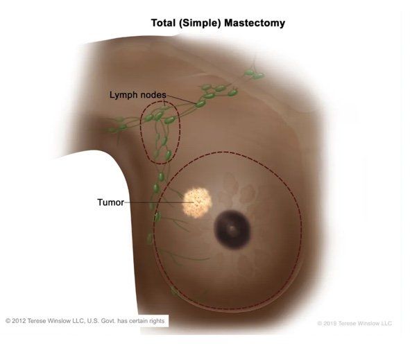 Breast Cancer Treatment