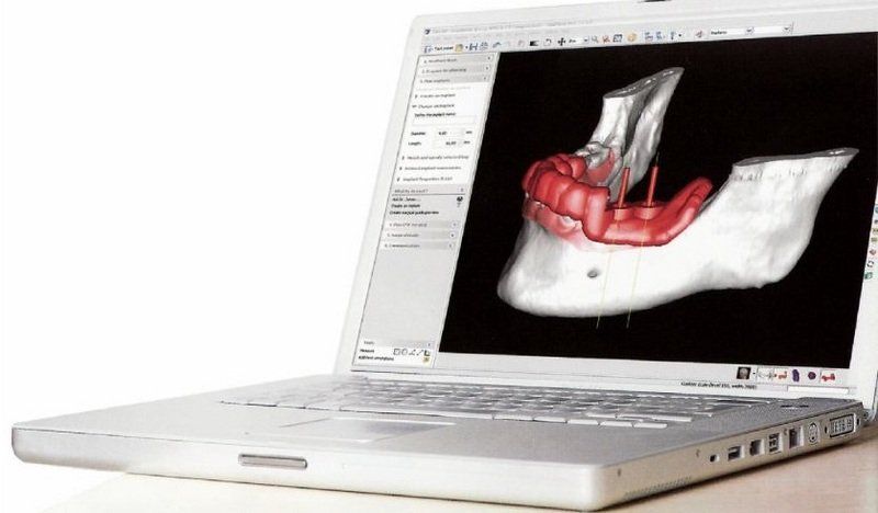 pc per implantologia guidata
