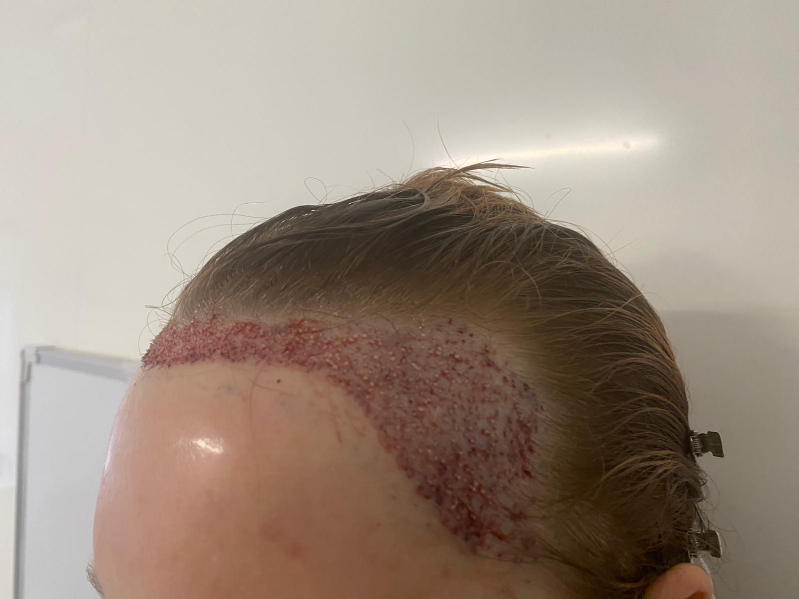A female patient undergoing a FUE hair transplant