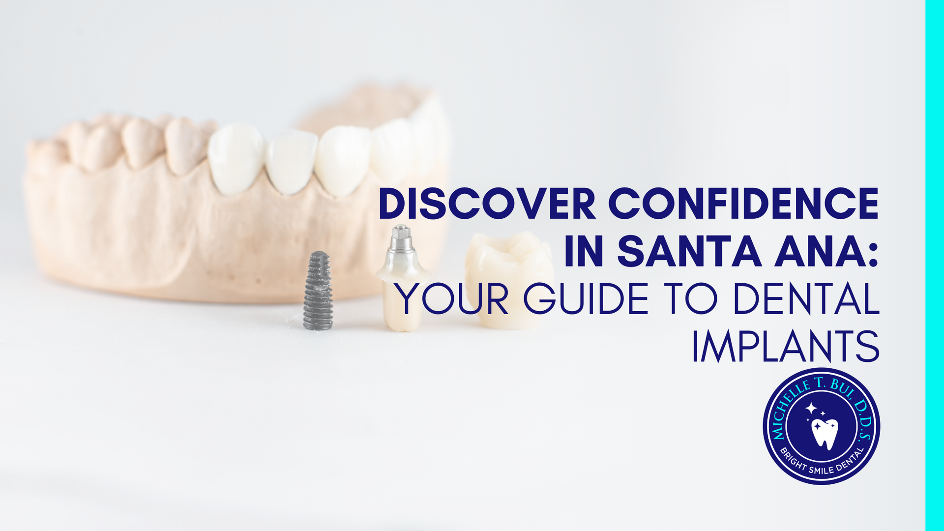 discover confidence in santa ana : your guide to dental implants
