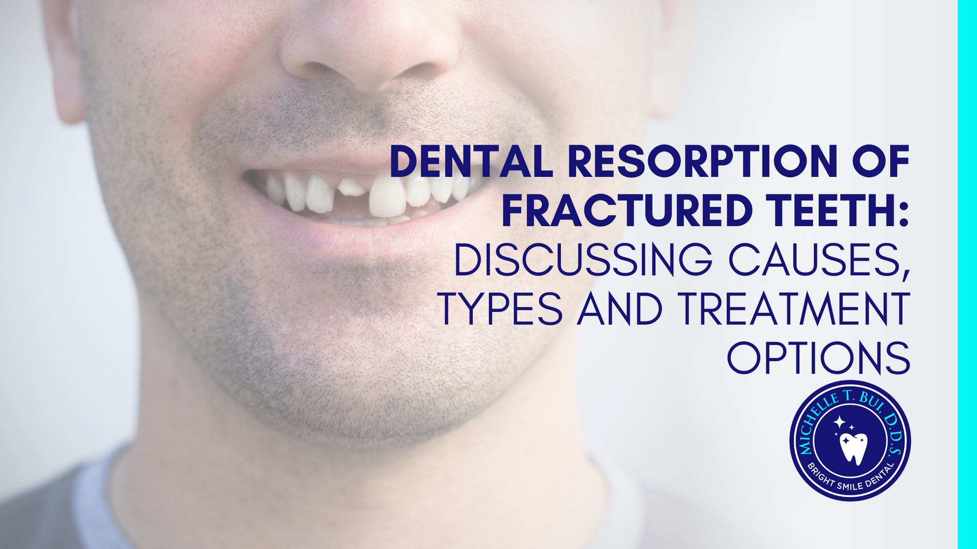 dental resorption of fractured teeth : discussing causes , types and treatment options