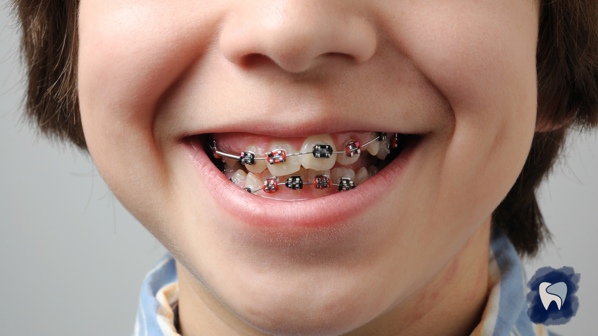 A young boy with braces on his teeth is smiling.