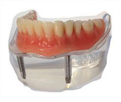 Upper denture model with visible false teeth set in pink gums, anchored by two metal screws — Maroochy Denture Clinic In Yandina, QLD