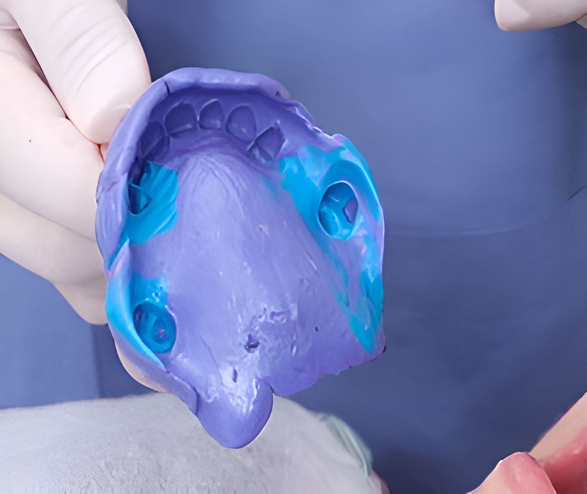 A Person is Holding a Purple and Blue Dental Impression — Maroochy Denture Clinic In Yandina, QLD