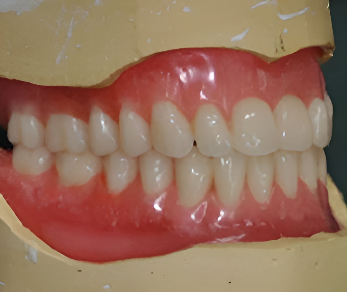 A Close Up of a Model of a Person's Teeth — Maroochy Denture Clinic In Yandina, QLD