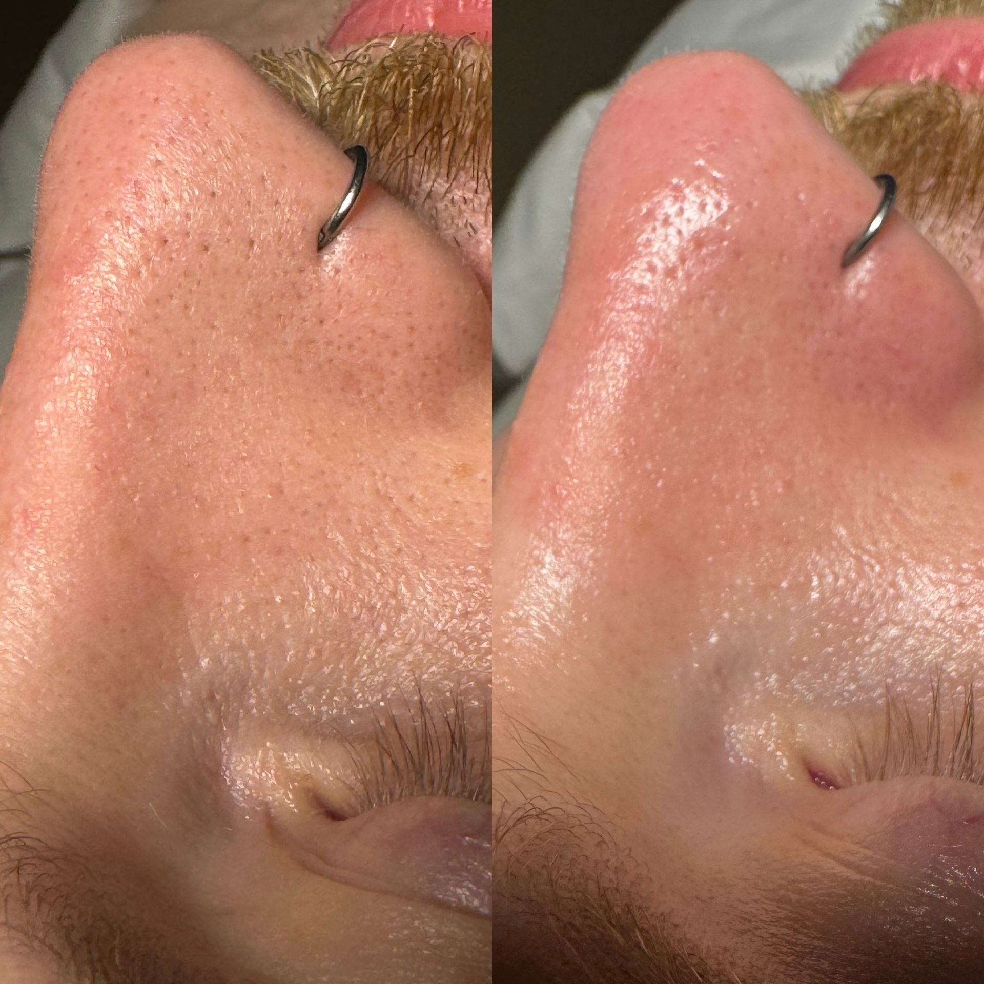 dermaplaning example
