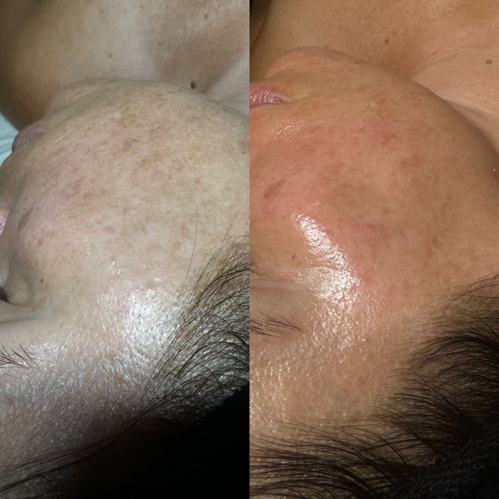 Dermaplaning example
