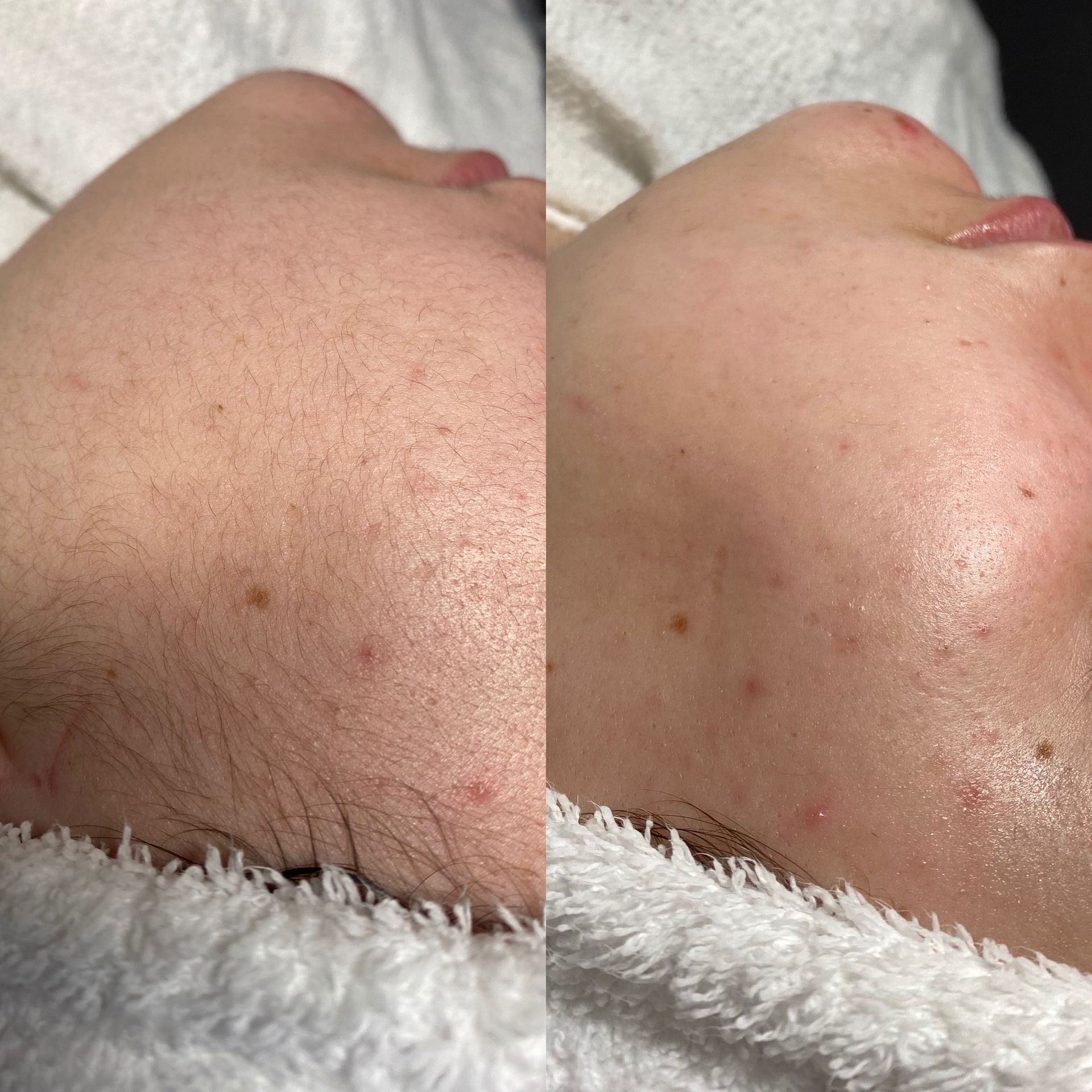 Dermaplaning example