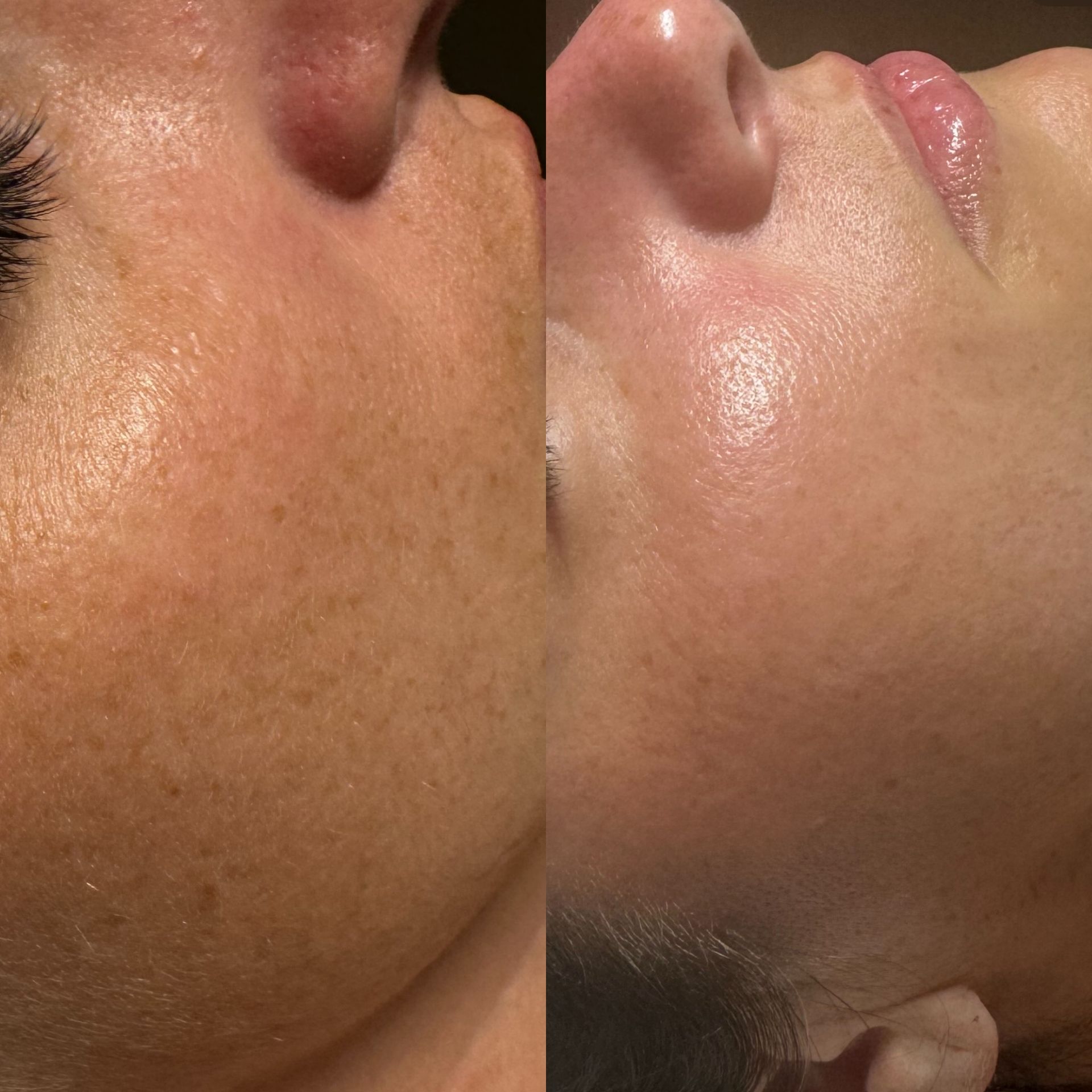 Dermaplaning example