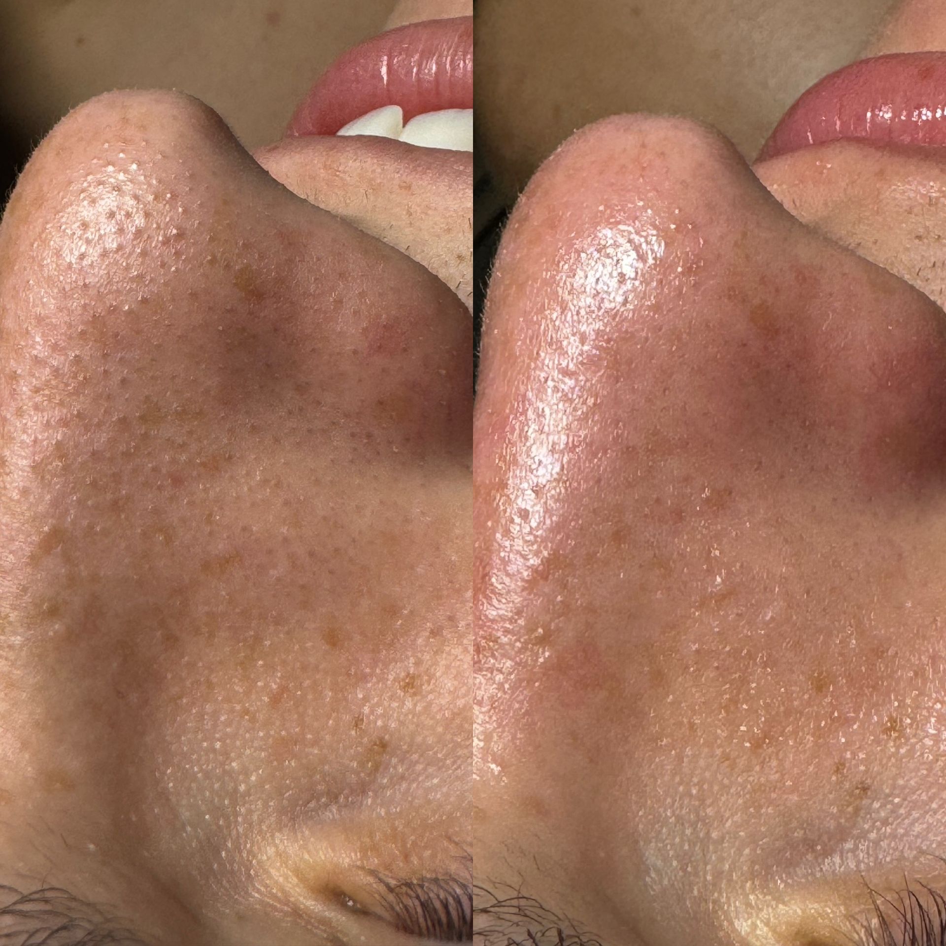 Dermaplaning example