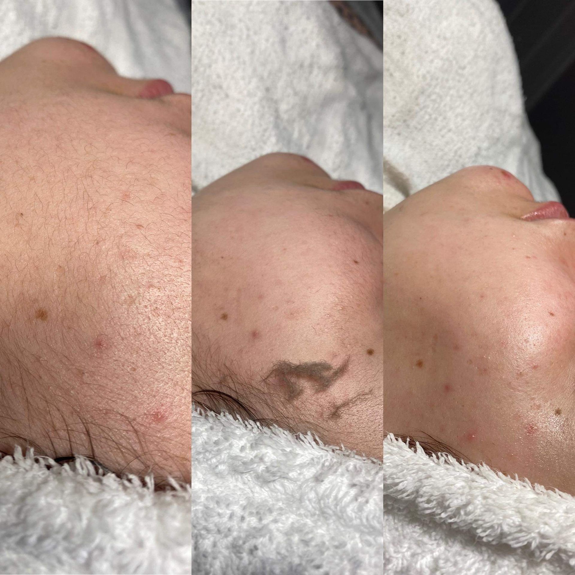 Dermaplaning Example