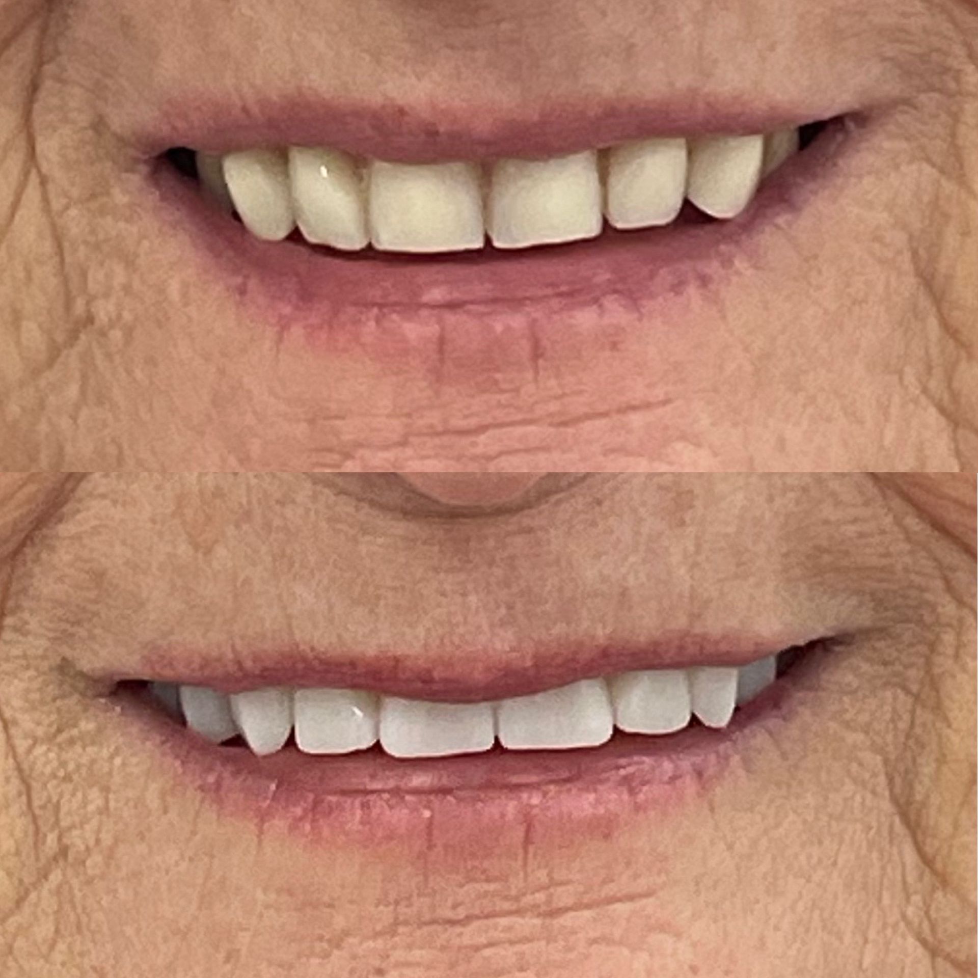Comparison of two smiles; top smile has discolored teeth. Bottom smile displays brighter, whiter teeth.— Dentures Direct Ballina In Ballina, NSW