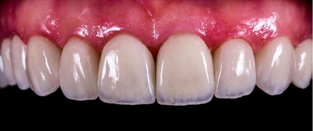 Front Teeth Repair: Bonding, Crowns or Veneers? - Healthy Smiles Family  Dentistry LLC LaGrange Georgia