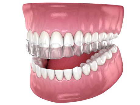 Invisalign®