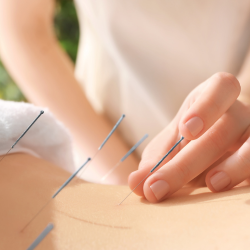 person getting acupuncture in the back