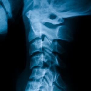 Subluxation In Spine