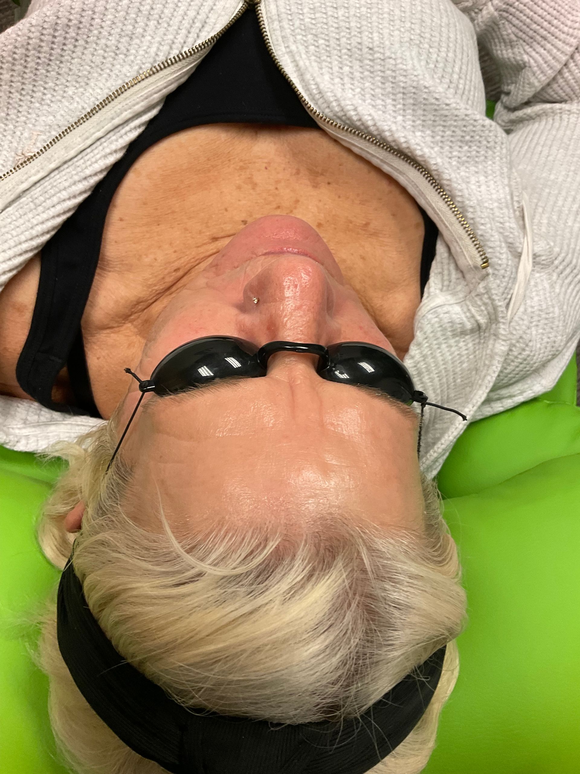 laser treatment eyes covered