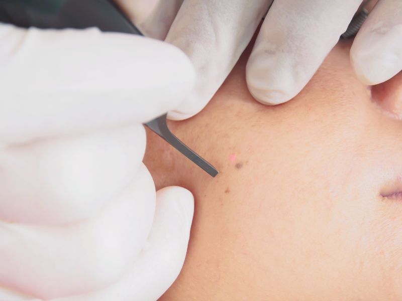 A gloved hand uses a laser tool on a person's cheek to remove a mole.