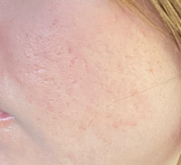 Woman's face with reduced acne scars after laser resurfacing