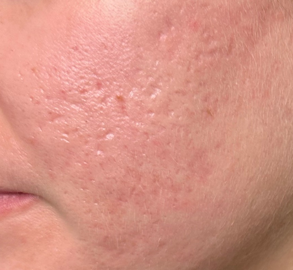 Woman's face with acne scars before laser resurfacing