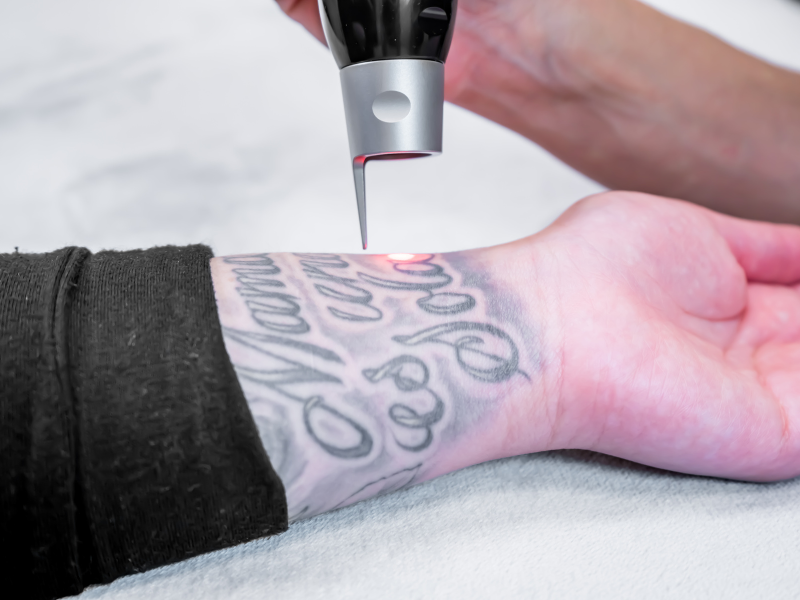 female beautician performing tattoo removal servuce