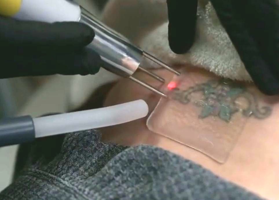 a man giving laser tattoo removal