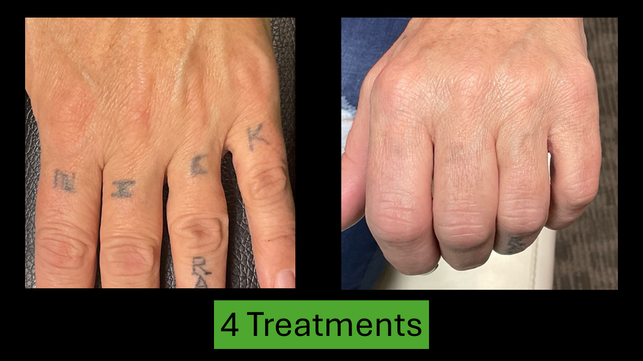 Two hands, before and after tattoo removal treatments. The right hand shows significant fading.
