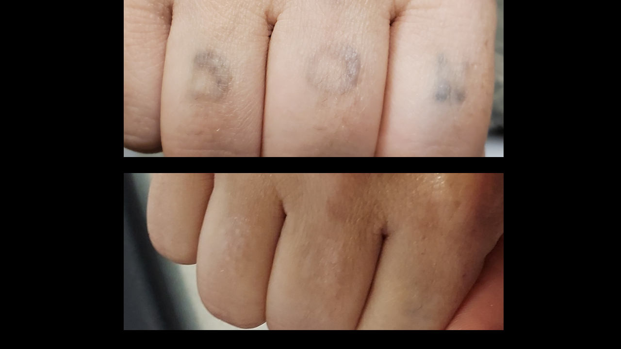 tattoo removal example