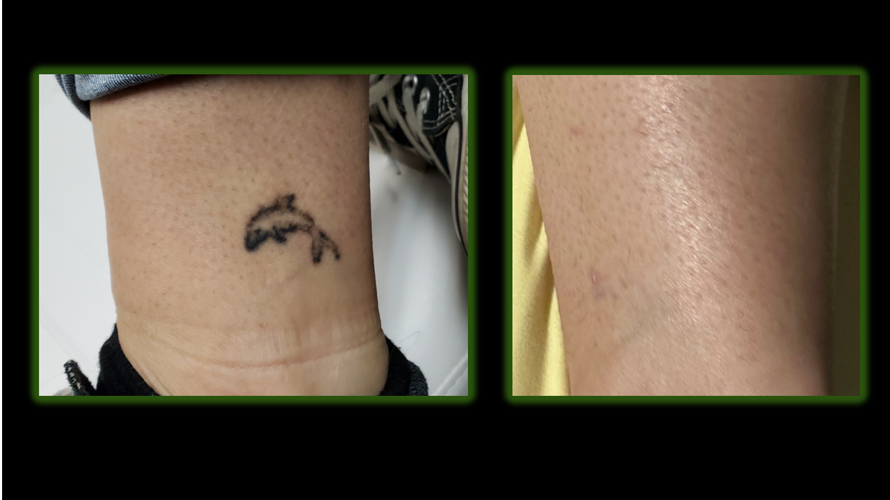 tattoo removal example
