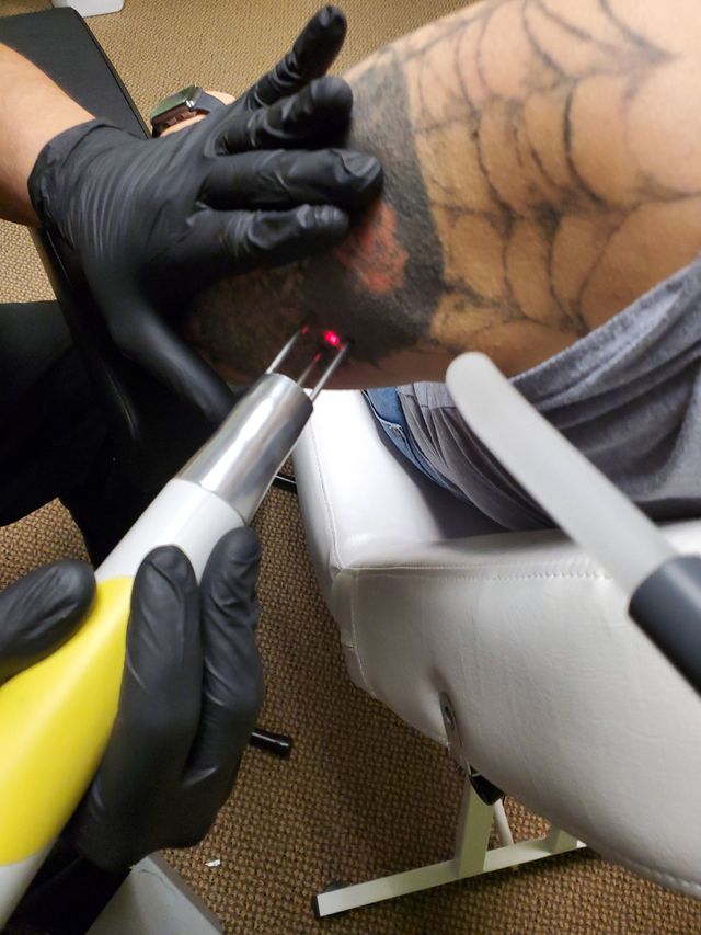 23+ Tattoo Removal Colorado Springs