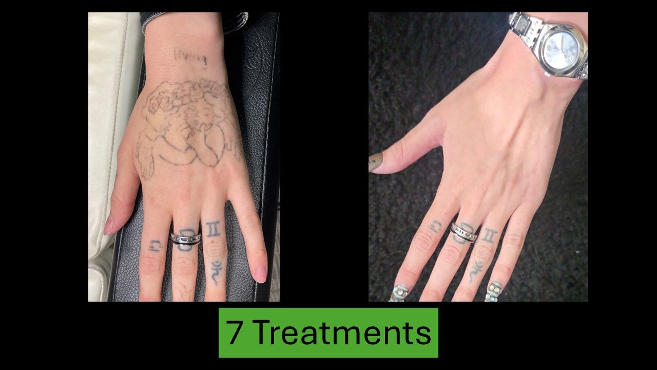 Comparison of a hand with a faded tattoo after 7 treatments, versus a hand with a completed tattoo.