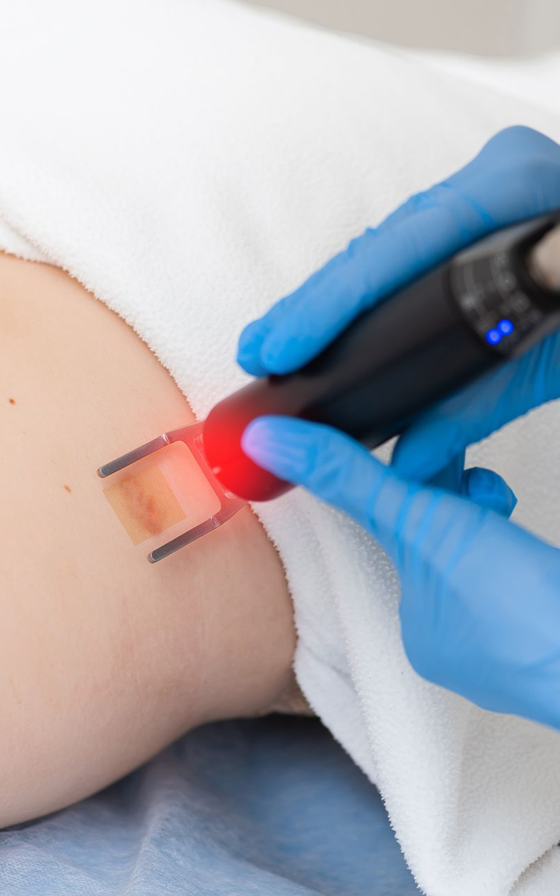 A person's arm is undergoing laser skin treatment with a red laser device.
