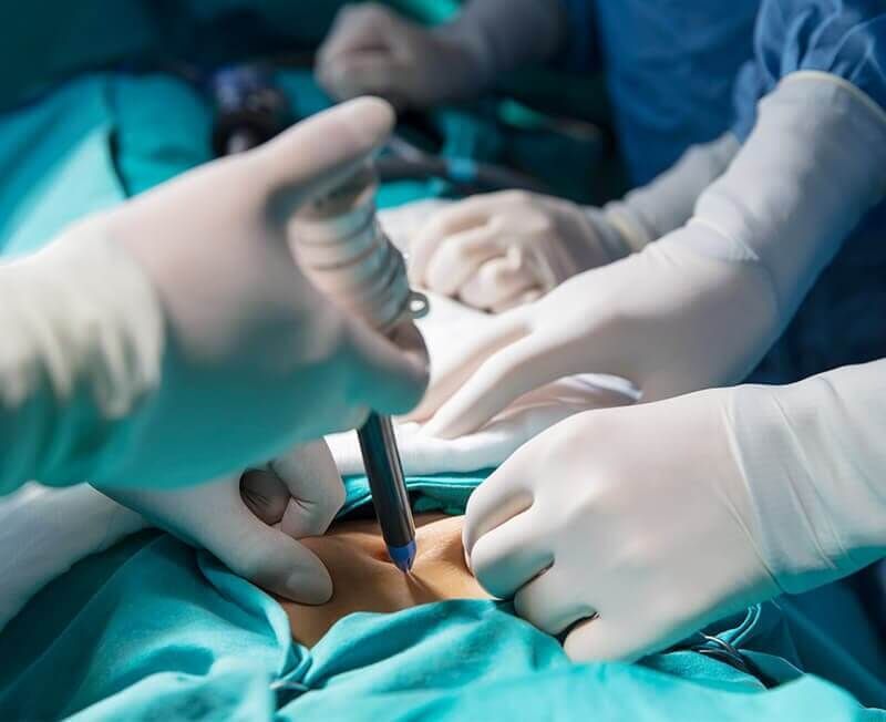 Un grupo de cirujanos está realizando una cirugía a un paciente en un quirófano.