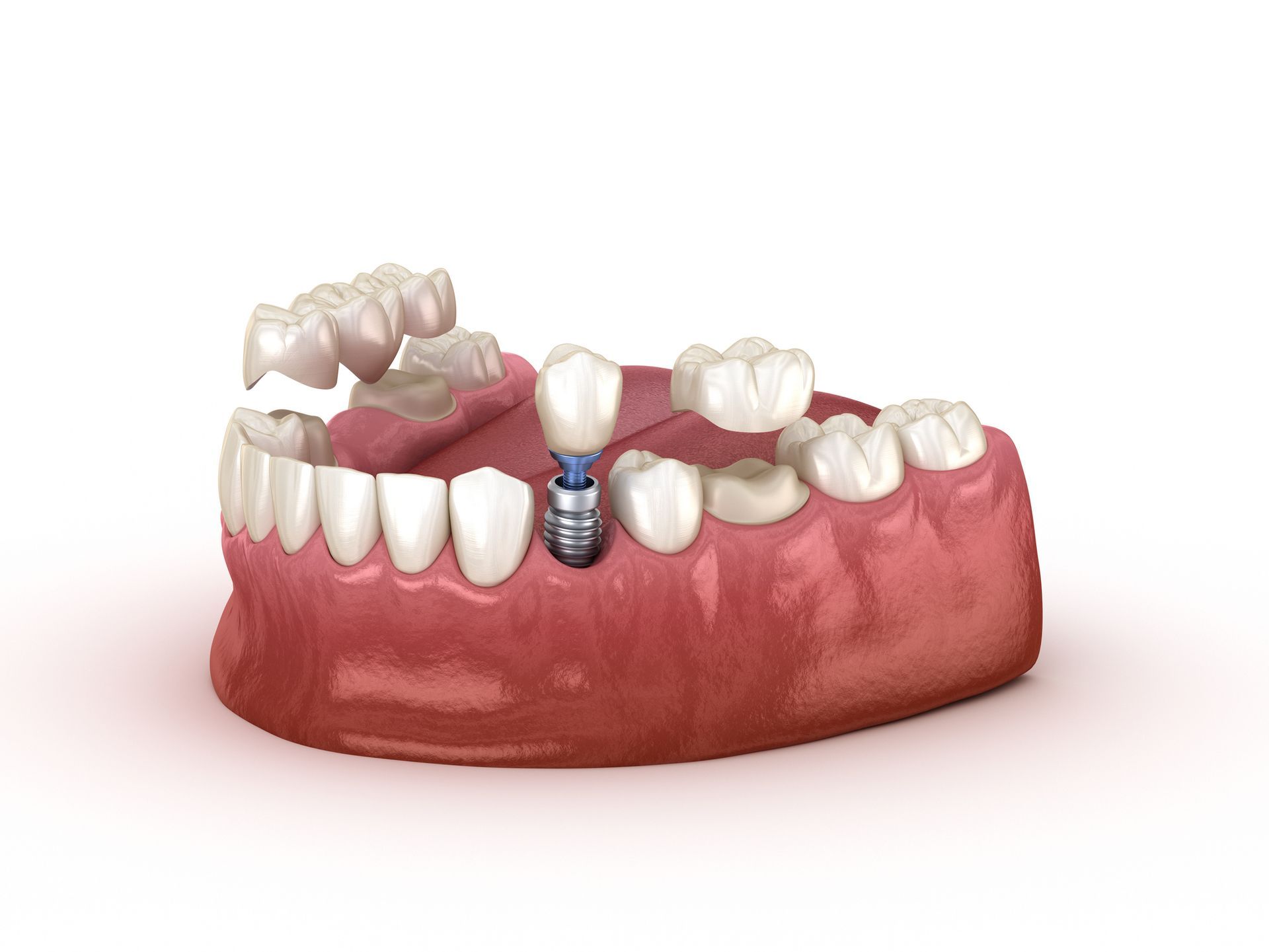 Model of dental implants in a jawbone. One implant is topped with a crown, another is part of a bridge.