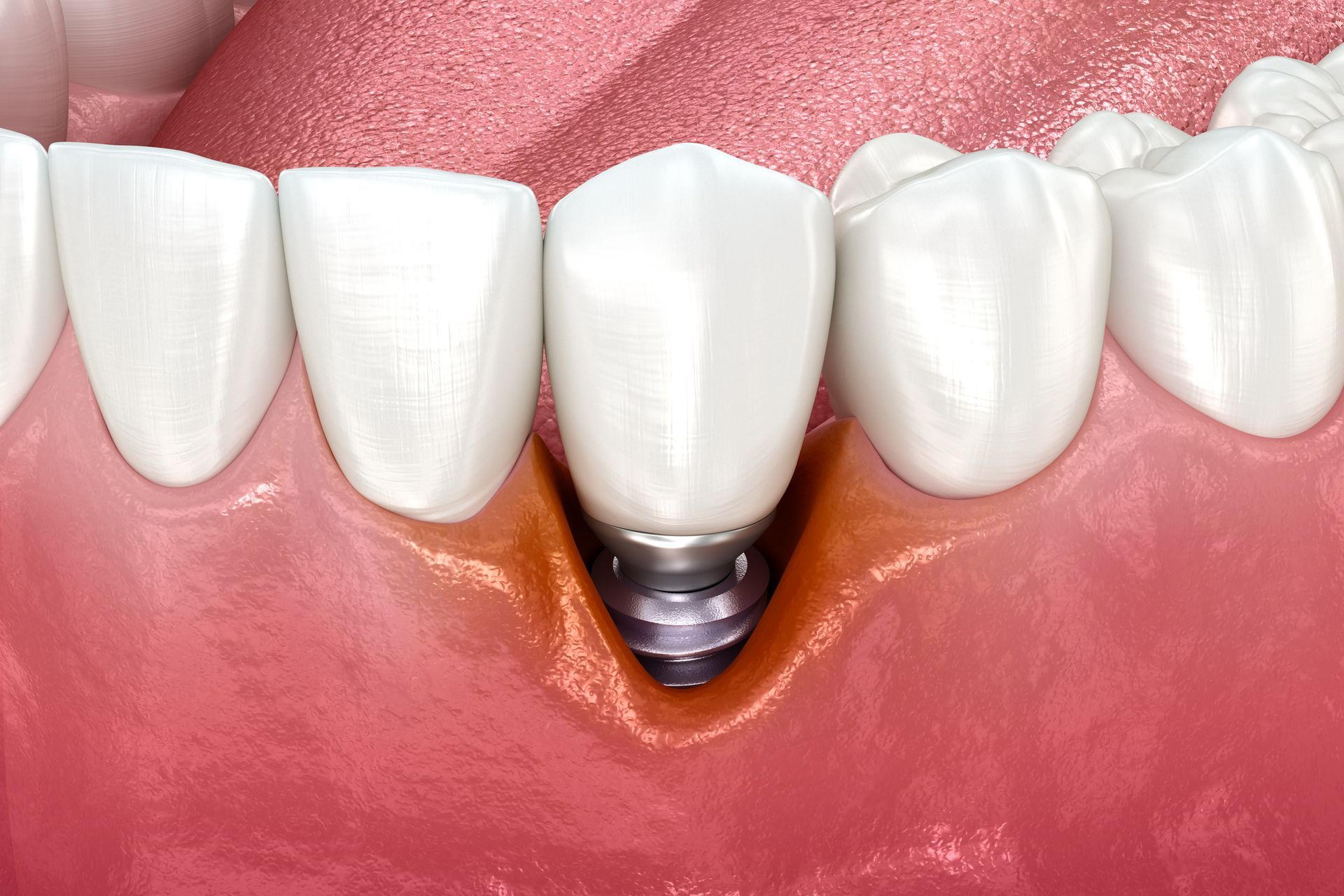 A close up of a tooth with a dental implant in it.