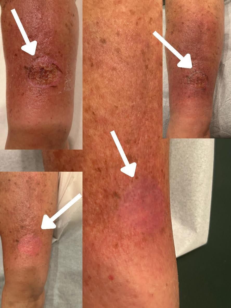 Weeping Wounds and Integrative Medical Acupuncture