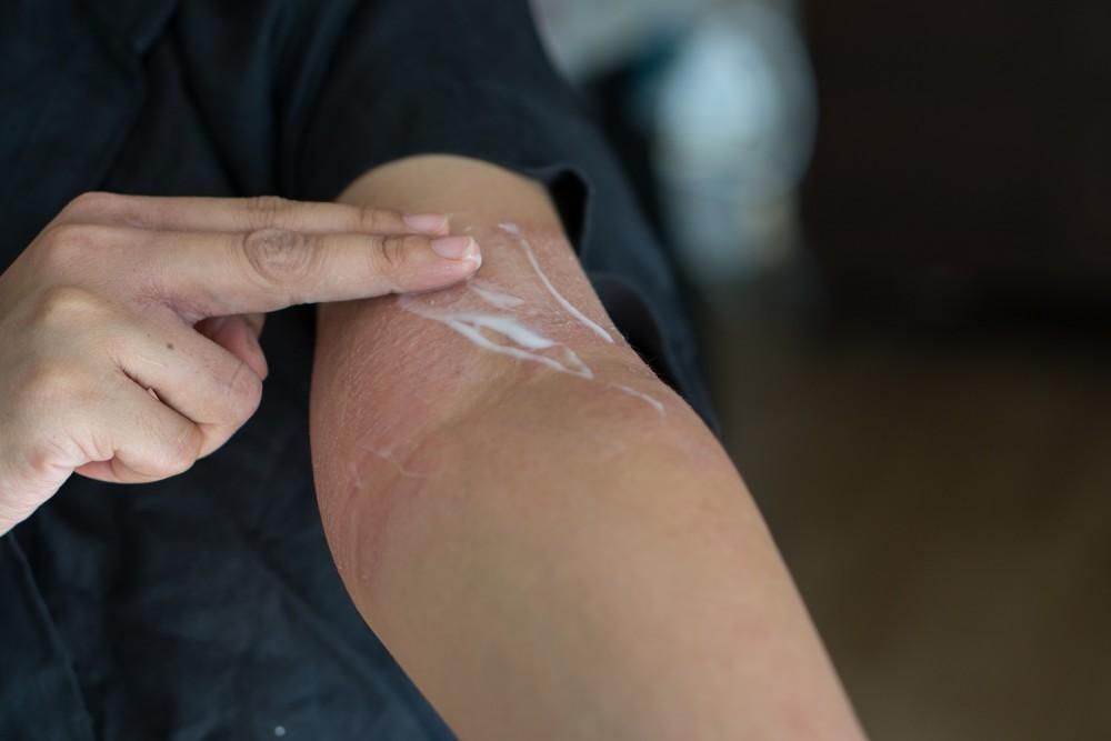 eczema rash causes