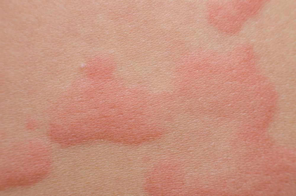 chronic hives