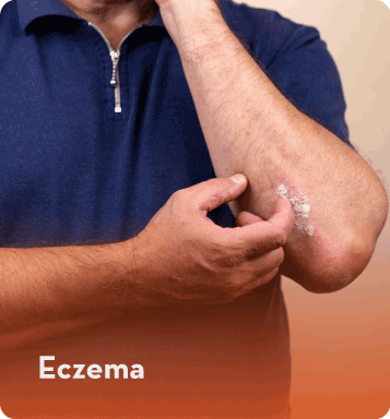 eczema