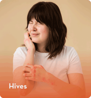 hives specialist