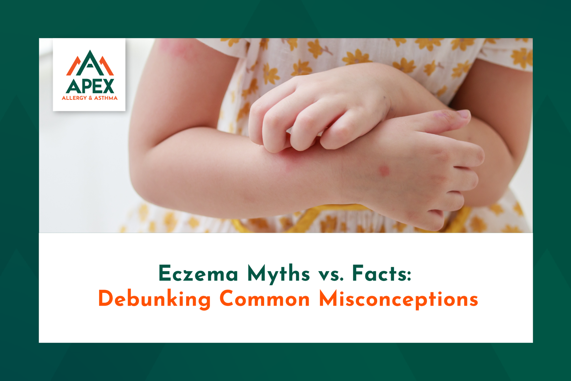 Eczema causes and triggers in the environment exacerbate a child’s symptoms.