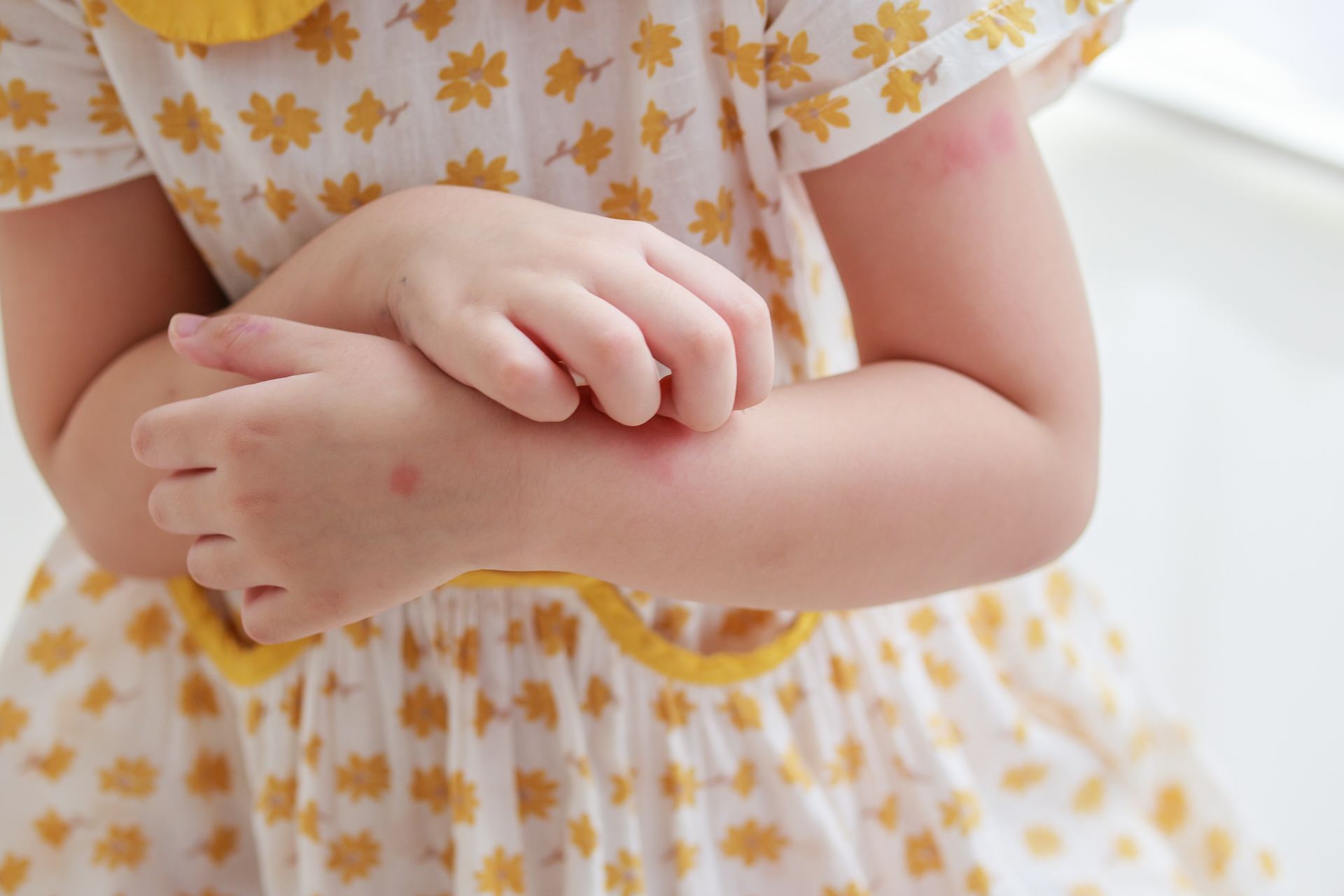 Eczema causes and triggers in the environment exacerbate a child’s symptoms.