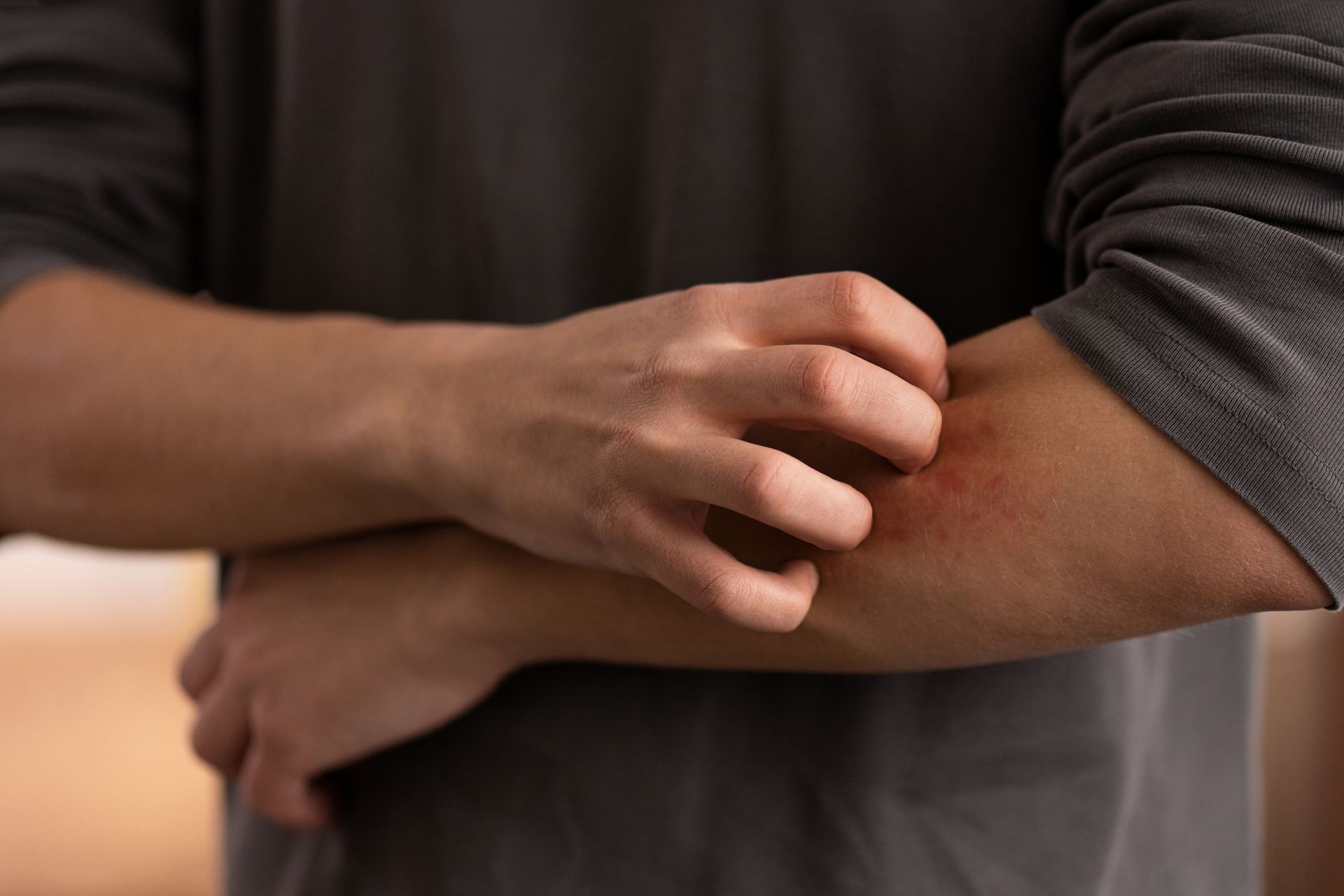 A man scratches the itchy bumps on his arm, one of the typical stress-induced hives symptoms. 