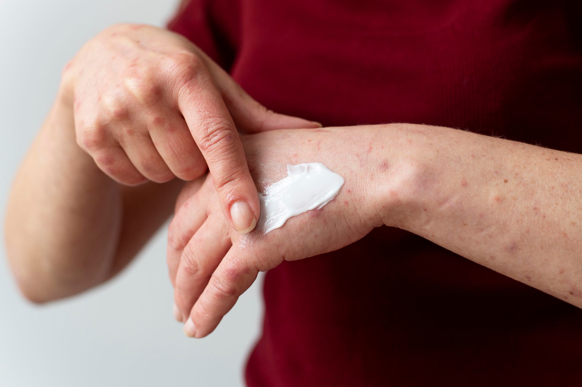 After reading about debunking eczema myths, a woman applies a moisturizing cream to treat the rashes on her hand.